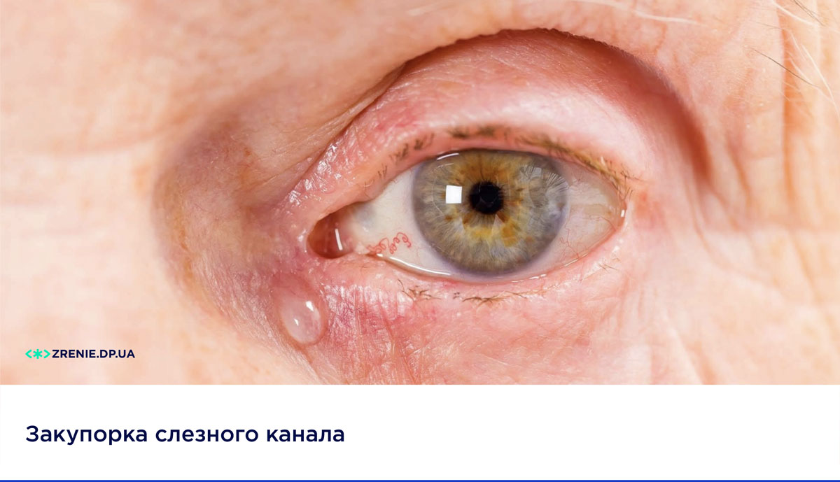 Закупорка слезного канала