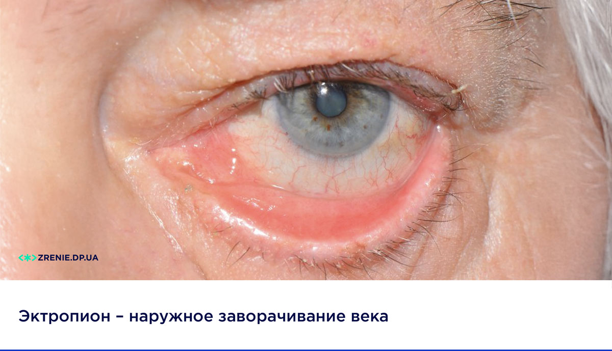 Нарушение строения век